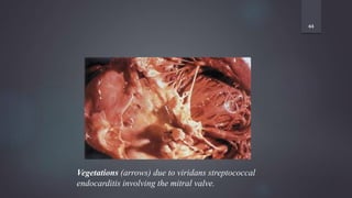 44
Vegetations (arrows) due to viridans streptococcal
endocarditis involving the mitral valve.
 