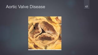 Aortic Valve Disease 45
 