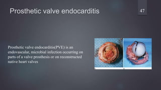 Prosthetic valve endocarditis 47
Prosthetic valve endocarditis(PVE) is an
endovascular, microbial infection occurring on
parts of a valve prosthesis or on reconstructed
native heart valves
 