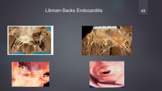 Libman-Sacks Endocarditis 48
 