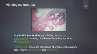 Bracht-Wachter bodies are a finding in infective
endocarditis consisting of yellow-white miliary spots in
the myocardium.
Histologically, these are collections of chronic inflammatory
cells, mainly lymphocytes and histiocytes
49
Histological features
 