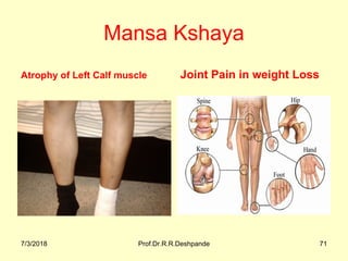 Mansa Kshaya
Atrophy of Left Calf muscle Joint Pain in weight Loss
7/3/2018 Prof.Dr.R.R.Deshpande 71
 