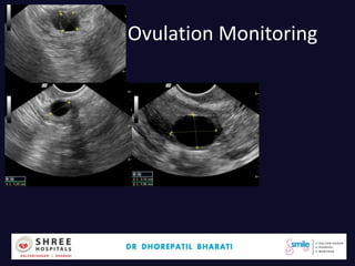Ovulation Monitoring
Dr.Bharati Dhorepatil 34
 