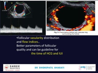 Dr.Bharati Dhorepatil 40
•Follicular vasularity distribution
and flow indices..
Better parameters of follicular
quality and can be guideline for
the time of HCG and IUI
 