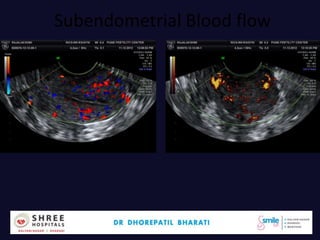 Subendometrial Blood flow
Dr.Bharati Dhorepatil 43
 