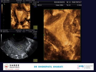 Endometerium
Dr.Bharati Dhorepatil 44
 