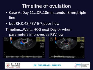 Timeline of ovulation
• Case A..Day 11…DF..18mm,..endo..8mm,triple
line
• but RI<0.48,PSV 6-7,poor flow
Timeline…Wait…HCG next Day or when
parameters improves as PSV low
Dr.Bharati Dhorepatil 45
 