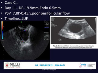 • Case C..
• Day 11…DF..19.9mm,Endo 6.5mm
• PSV 7,RI>0.45,v.poor perifollicular flow
• Timeline…LUF..
Dr.Bharati Dhorepatil 47
 