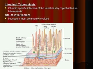 Intestinal TuberculosisIntestinal Tuberculosis
 Chronic specific infection of the intestines by mycobacteriumChronic specific infection of the intestines by mycobacterium
tuberculosistuberculosis
site of involvementsite of involvement
 ileocecum most commonly involvedileocecum most commonly involved
11
 