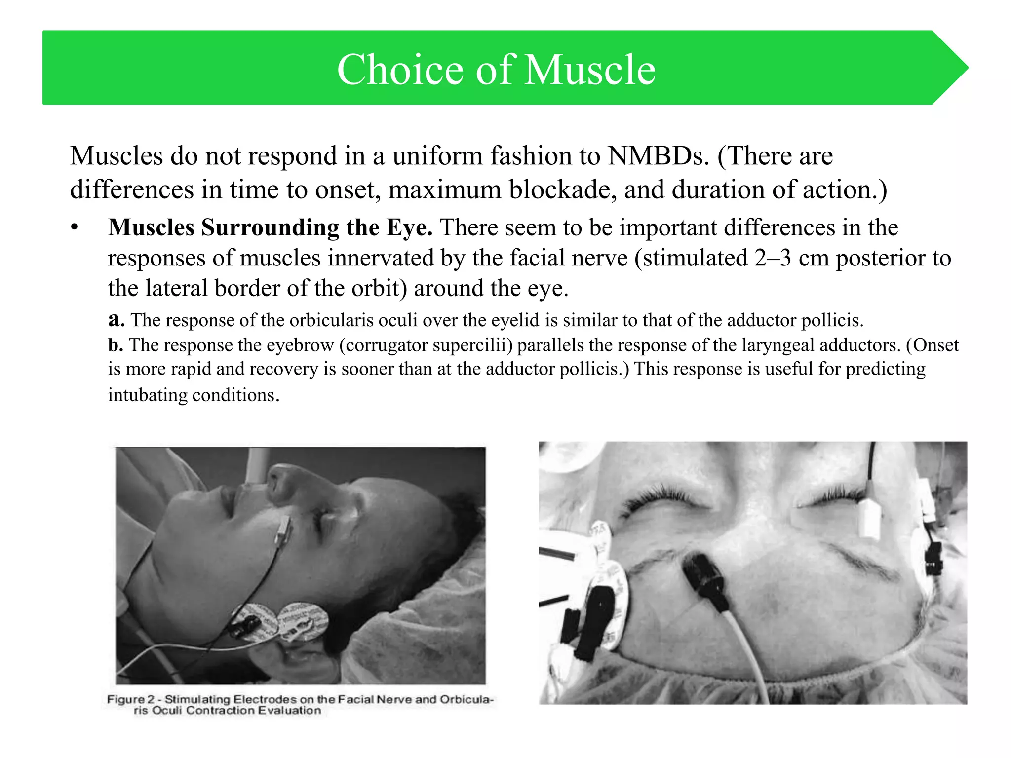 Muscles do not respond in a uniform fashion to NMBDs. (There are
differences in time to onset, maximum blockade, and duration of action.)
• Muscles Surrounding the Eye. There seem to be important differences in the
responses of muscles innervated by the facial nerve (stimulated 2–3 cm posterior to
the lateral border of the orbit) around the eye.
a. The response of the orbicularis oculi over the eyelid is similar to that of the adductor pollicis.
b. The response the eyebrow (corrugator supercilii) parallels the response of the laryngeal adductors. (Onset
is more rapid and recovery is sooner than at the adductor pollicis.) This response is useful for predicting
intubating conditions.
Choice of Muscle
 