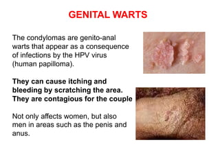 GENITAL WARTS
The condylomas are genito-anal
warts that appear as a consequence
of infections by the HPV virus
(human papilloma).
They can cause itching and
bleeding by scratching the area.
They are contagious for the couple
Not only affects women, but also
men in areas such as the penis and
anus.
 