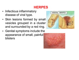 HERPES
Infectious inflammatory
disease of viral type.
Skin lesions formed by small
vesicles grouped in a cluster
and surrounded by a red ring.
Genital symptoms include the
•
•
•
appearance
blisters
of small, painful
 