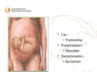• Lie:-
– Transverse
• Presentation:-
– Shoulder
• Denominator:-
– Acromion
 