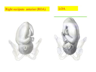 LOARight occiputo anterior (ROA)
 