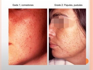 Gade 1; comedones Grade 2: Papules, pustules
 