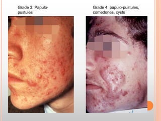 Grade 3: Papulo-
pustules
Grade 4: papulo-pustules,
comedones, cysts
 