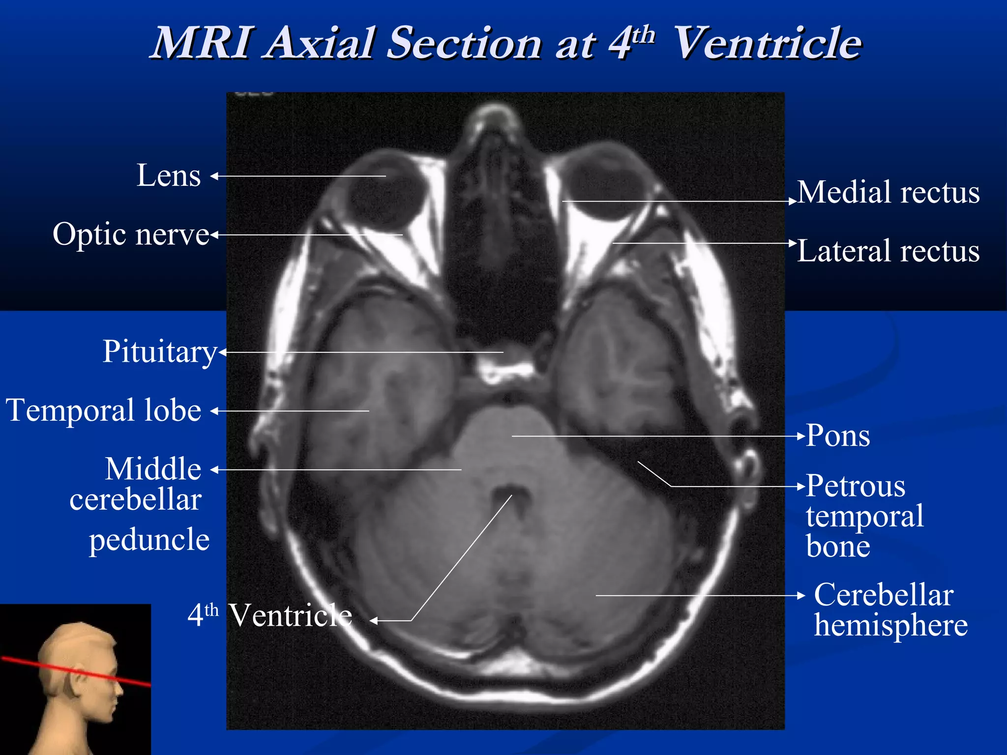 Radiological Techniques of brain Space occupying lesion | PPT