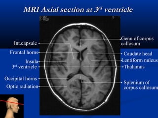 Uncus Radiopaedia Radiological Techniques of brain Space occupying lesion | PPT