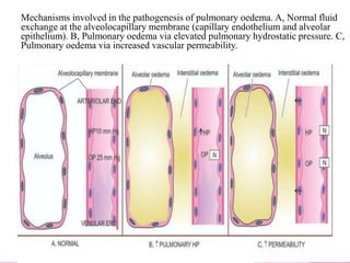 Mechanisms involved in the pathogenesis of pulmonary oedema. A, Normal fluid
exchange at the alveolocapillary membrane (capillary endothelium and alveolar
epithelium). B, Pulmonary oedema via elevated pulmonary hydrostatic pressure. C,
Pulmonary oedema via increased vascular permeability.
 