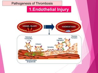 Pathogenesis of Thrombosis
1.Endothelial Injury
 