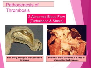 Pathogenesis of
Thrombosis
2.Abnormal Blood Flow
(Turbulence & Stasis)
Left atrial mural thrombus in a case of
rheumatic mitral stenosis
Iliac artery aneurysm with laminated
thrombus
 
