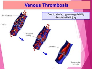 Venous Thrombosis
Due to stasis, hypercoagulability
&endothelial injury
 