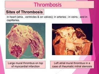 in heart (atria , ventricles & on valves); in arteries ; in veins ; and in
capillaries.
Thrombosis
Large mural thrombus on top
of myocardial infarction
Left atrial mural thrombus in a
case of rheumatic mitral stenosis
Sites of Thrombosis
 