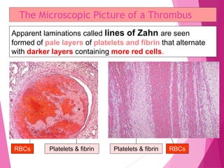 The Microscopic Picture of a Thrombus
Apparent laminations called lines of Zahn are seen
formed of pale layers of platelets and fibrin that alternate
with darker layers containing more red cells.
RBCs Platelets & fibrin Platelets & fibrin RBCs
 