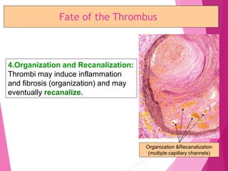 Fate of the Thrombus
4.Organization and Recanalization:
Thrombi may induce inflammation
and fibrosis (organization) and may
eventually recanalize.
Organization &Recanalization
(multiple capillary channels)
 