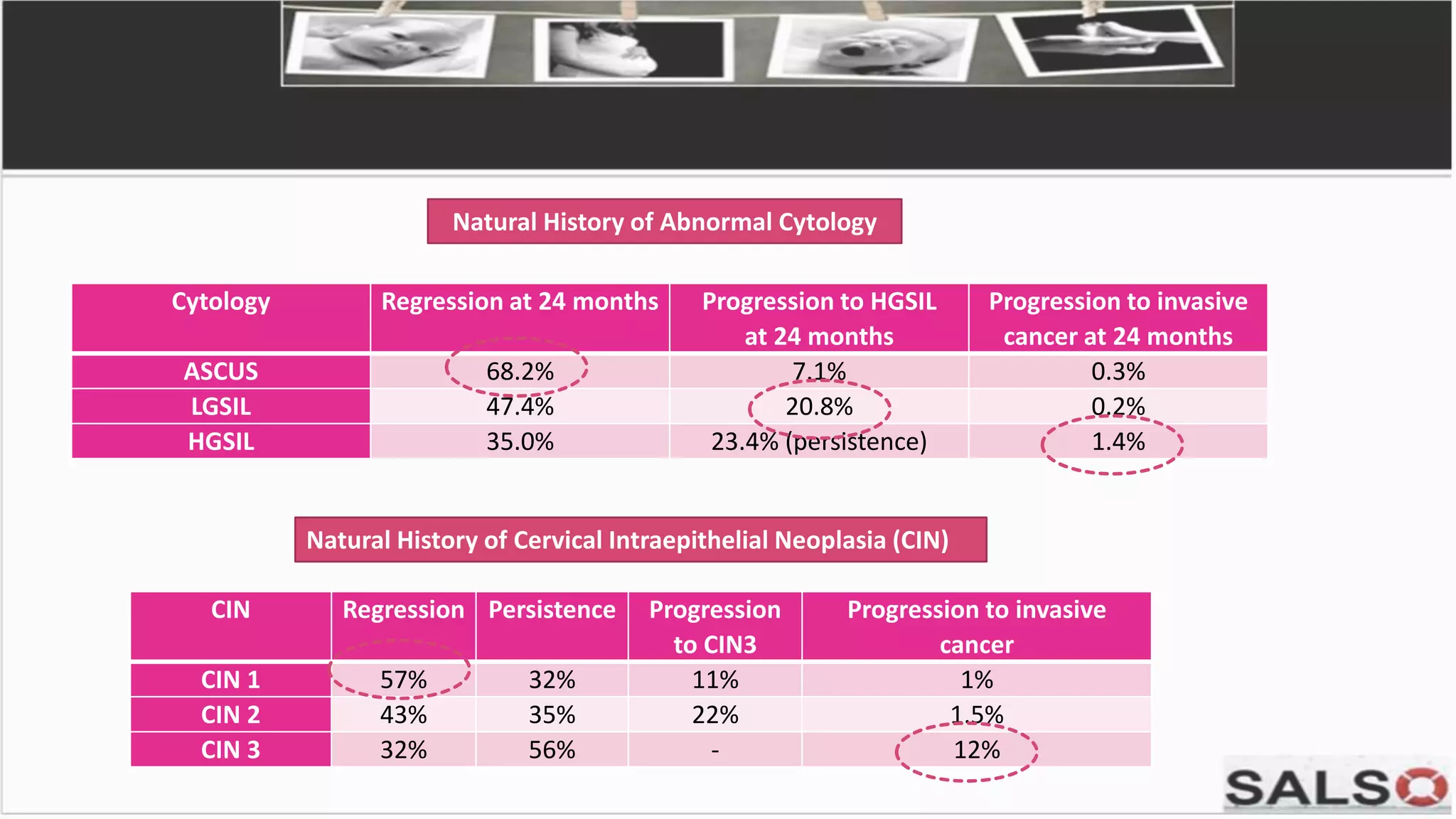 Cytology Regression at 24 months Progression to HGSIL
at 24 months
Progression to invasive
cancer at 24 months
ASCUS 68.2% 7.1% 0.3%
LGSIL 47.4% 20.8% 0.2%
HGSIL 35.0% 23.4% (persistence) 1.4%
CIN Regression Persistence Progression
to CIN3
Progression to invasive
cancer
CIN 1 57% 32% 11% 1%
CIN 2 43% 35% 22% 1.5%
CIN 3 32% 56% - 12%
Natural History of Abnormal Cytology
Natural History of Cervical Intraepithelial Neoplasia (CIN)
 