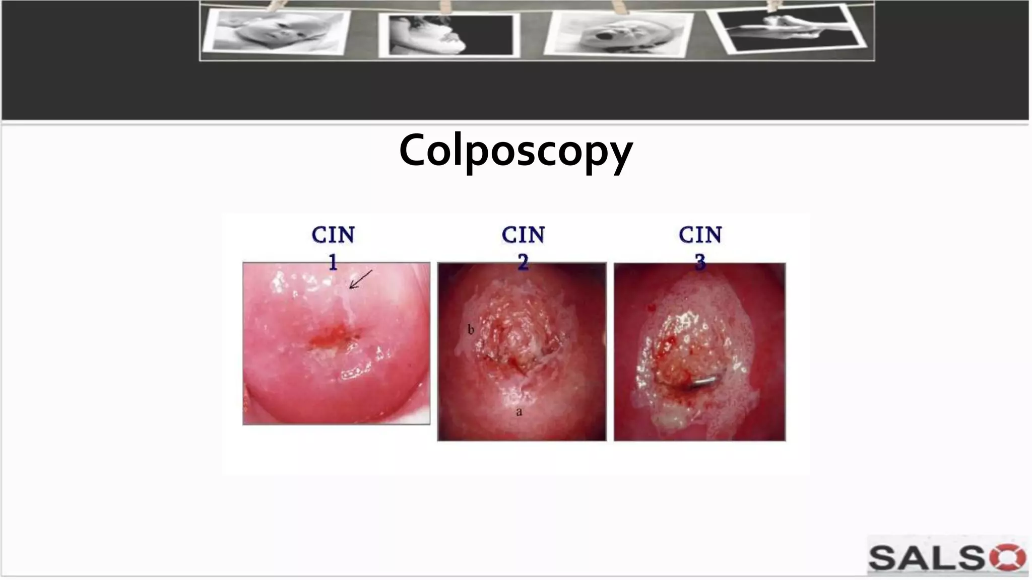 Colposcopy
 