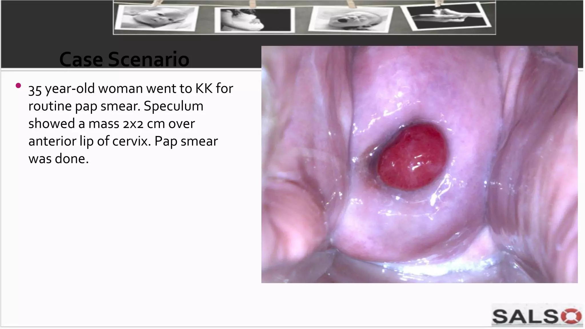 Case Scenario
• 35 year-old woman went to KK for
routine pap smear. Speculum
showed a mass 2x2 cm over
anterior lip of cervix. Pap smear
was done.
 