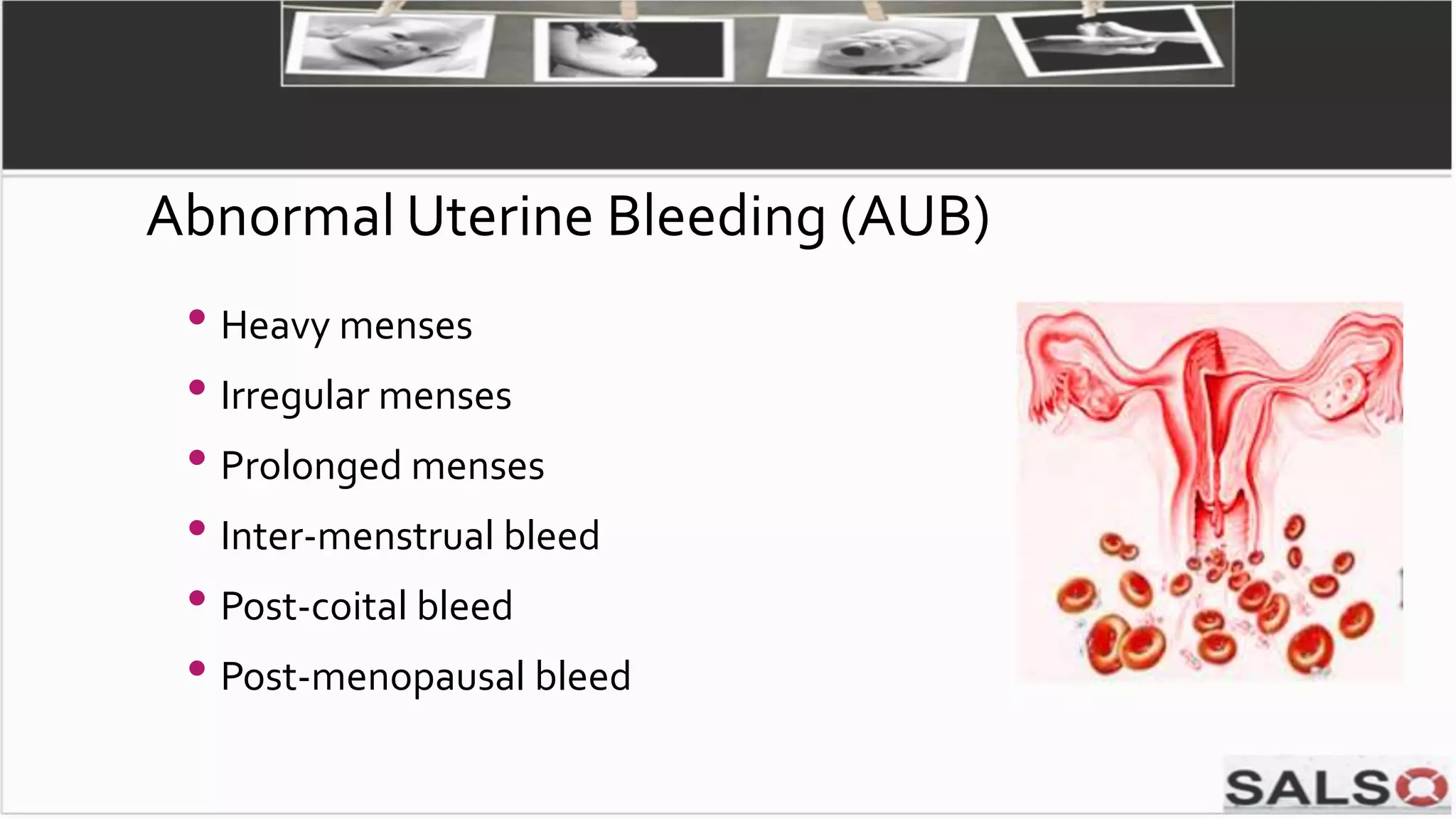 • Heavy menses
• Irregular menses
• Prolonged menses
• Inter-menstrual bleed
• Post-coital bleed
• Post-menopausal bleed
Abnormal Uterine Bleeding (AUB)
 