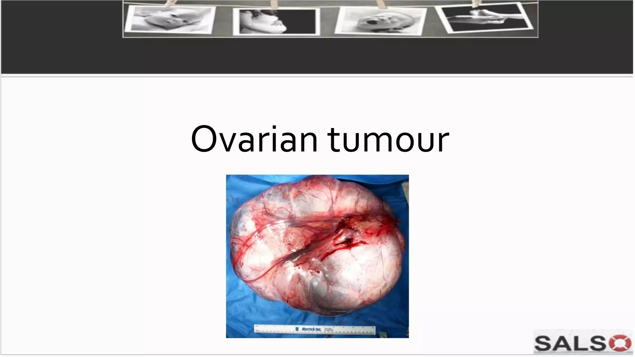 Ovarian tumour
 