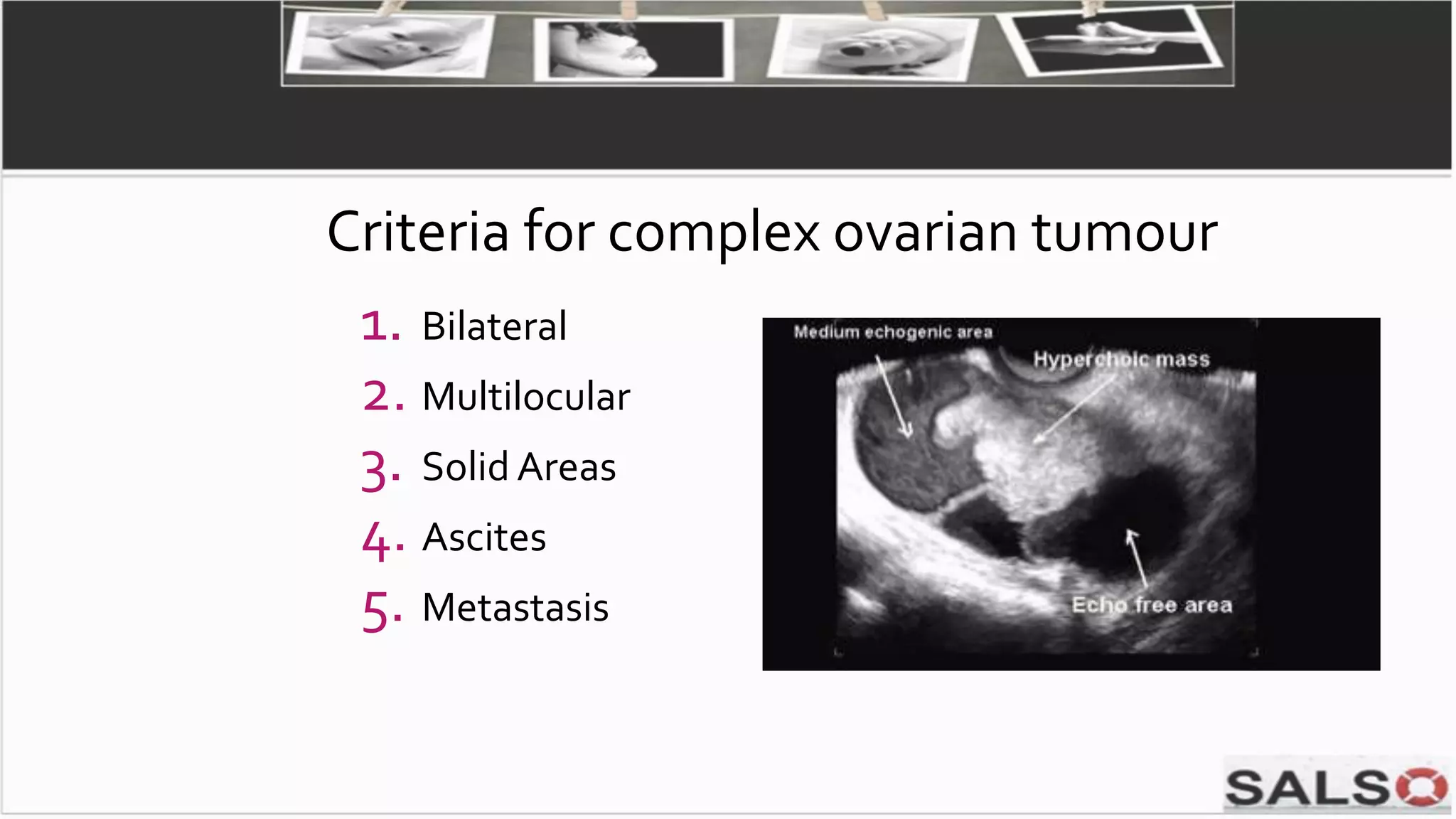 1. Bilateral
2. Multilocular
3. Solid Areas
4. Ascites
5. Metastasis
Criteria for complex ovarian tumour
 