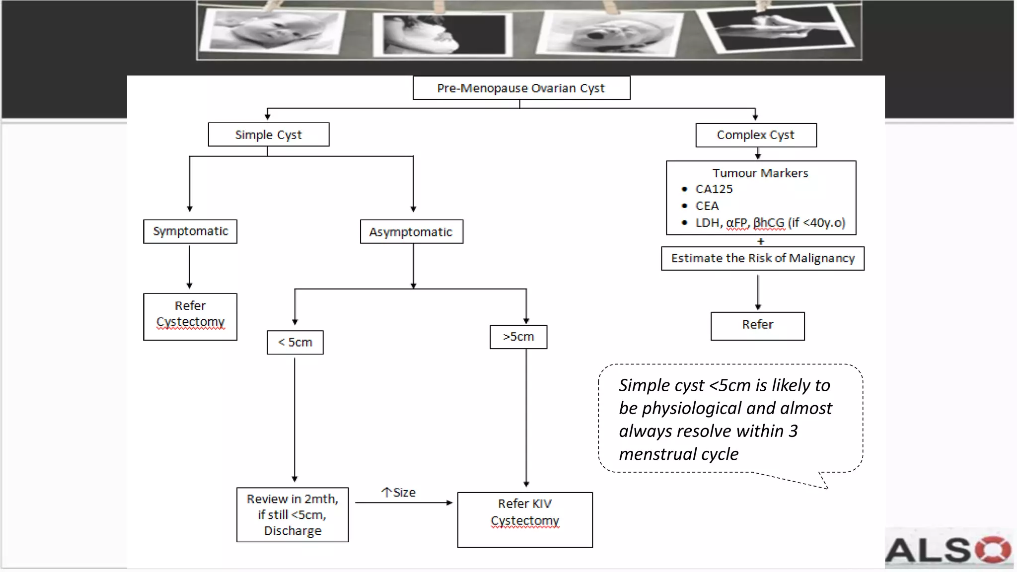 Simple cyst <5cm is likely to
be physiological and almost
always resolve within 3
menstrual cycle
 