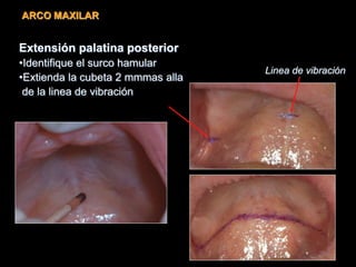 ARCO MAXILAR
Extensión palatina posterior
•Identifique el surco hamular
•Extienda la cubeta 2 mmmas alla
de la linea de vibración
Linea de vibración
 