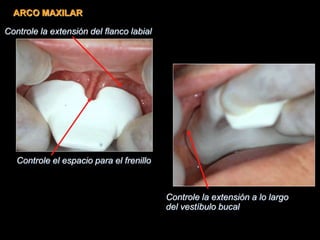 Controle la extensión a lo largo
del vestíbulo bucal
Controle la extensión del flanco labial
Controle el espacio para el frenillo
ARCO MAXILAR
 
