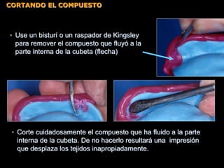 • Use un bisturí o un raspador de Kingsley
para remover el compuesto que fluyó a la
parte interna de la cubeta (flecha)
• Corte cuidadosamente el compuesto que ha fluido a la parte
interna de la cubeta. De no hacerlo resultará una impresión
que desplaza los tejidos inapropiadamente.
CORTANDO EL COMPUESTO
 