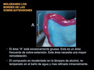 • El área “A” está excesivamente gruesa. Esta es un área
frecuente de sobre-extensión. Este área necesita una mayor
remodelación.
• El compuesto es recalentado en la lámpara de alcohol, re-
temperado en el baño de agua y mas refinado intraoralmente.
A
MOLDEANDO LOS
BORDES DE LAS
SOBRE-EXTENSIONES
 