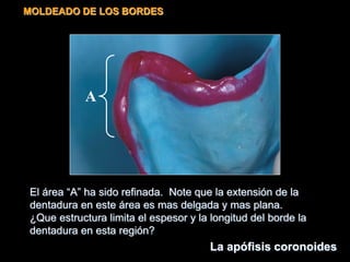 El área “A” ha sido refinada. Note que la extensión de la
dentadura en este área es mas delgada y mas plana.
¿Que estructura limita el espesor y la longitud del borde la
dentadura en esta región?
A
MOLDEADO DE LOS BORDES
La apófisis coronoides
 