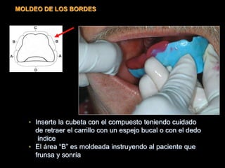 • Inserte la cubeta con el compuesto teniendo cuidado
de retraer el carrillo con un espejo bucal o con el dedo
índice
• El área “B” es moldeada instruyendo al paciente que
frunsa y sonría
MOLDEO DE LOS BORDES
 