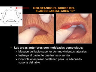 MOLDEANDO EL BORDE DEL
FLANCO LABIAL-AREA “C”
• Las áreas anteriores son moldeadas como sigue:
 Masage del labio superior con movimientos laterales
 Instruya al paciente que frunsa y sonría
 Controle el espesor del flanco para un adecuado
soporte del labio
 