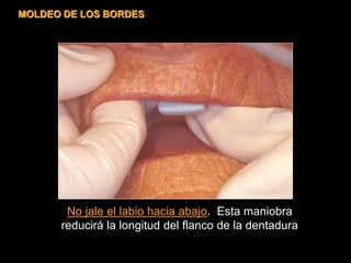 No jale el labio hacia abajo. Esta maniobra
reducirá la longitud del flanco de la dentadura
MOLDEO DE LOS BORDES
 