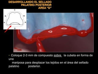 • Coloque 2-3 mm de compuesto sobre la cubeta en forma de
una
mariposa para desplazar los tejidos en el área del sellado
palatino posterior.
DESARROLLANDO EL SELLADO
PALATINO POSTERIOR
AREA “D”
 