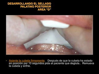 • Asiente la cubeta firmemente. Después de que la cubeta ha estado
en posición por 10 segundos pida al paciente que degluta.. Remueva
la cubeta y enfrie.
DESARROLLANDO EL SELLADO
PALATINO POSTERIOR
AREA “D”
 