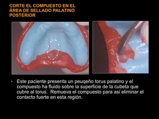 CORTE EL COMPUESTO EN EL
ÁREA DE SELLADO PALATINO
POSTERIOR
• Este paciente presenta un peuqeño torus palatino y el
compuesto ha fluido sobre la superficie de la cubeta que
cubre al torus. Remueva el compuesto para asi eliminar el
contacto fuerte en esta región.
 