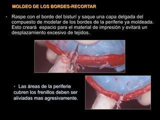 • Raspe con el borde del bisturí y saque una capa delgada del
compuesto de modelar de los bordes de la periferie ya moldeada.
Esto creará espacio para el material de impresión y evitará un
desplazamiento excesivo de tejidos.
• Las áreas de la periferie
cubren los frenillos deben ser
aliviadas mas agresivamente.
MOLDEO DE LOS BORDES-RECORTAR
 