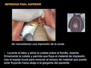 • Levante el labio y alinie la cubeta sobre el frenillo. Asiente
fírmemente la cubeta y permita que fluya el material de impresión.
Use el espejo bucal para remover el exceso de material que pueda
estar fluyendo hacia abajo a la garganta del paciente.
No necesitamos una impresión de la úvula.
IMPRESION FINAL SUPERIOR
 