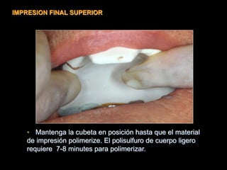 • Mantenga la cubeta en posición hasta que el material
de impresión polimerize. El polisulfuro de cuerpo ligero
requiere 7-8 minutes para polimerizar.
IMPRESION FINAL SUPERIOR
 